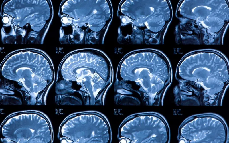 Brain MRI